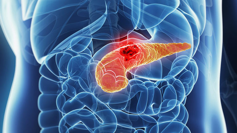 Το πρόχειρο φαγητό εκτιμάται ότι αύξησε τη συχνότητα του καρκίνου του παγκρέατος σε άτομα νεαρότερης ηλικίας