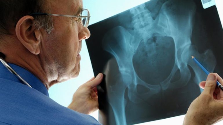 Η θεραπεία με DHEA προλαμβάνει την οστική απώλεια στις γυναίκες