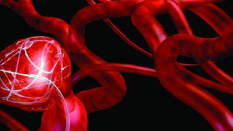 Θεσσαλονίκη: Ανευρύσματα και φλεβική θρόμβωση τα πιο επικίνδυνα από τα αγγειακά νοσήματα