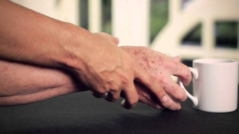 Ο συνδυασμός δύο ουσιών του καφέ καταπολεμά τη νόσο Πάρκινσον