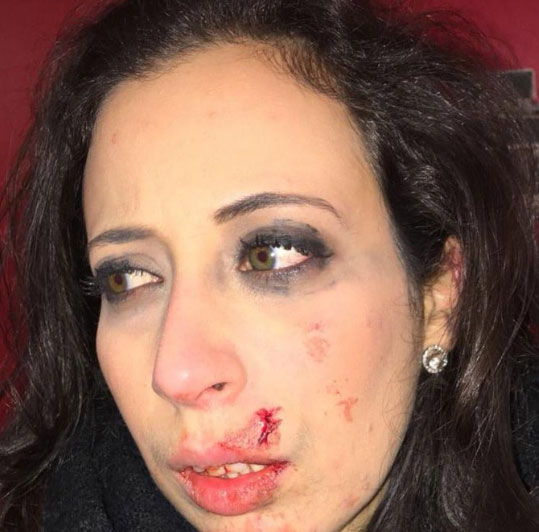 Η ανταποκρίτρια του RT δέχθηκε χτύπημα στο πρόσωπο από αστυνομικό