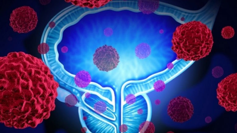 Συνδέεται το αυξημένο μέγεθος προστάτη με υψηλότερο κίνδυνο καρκίνου