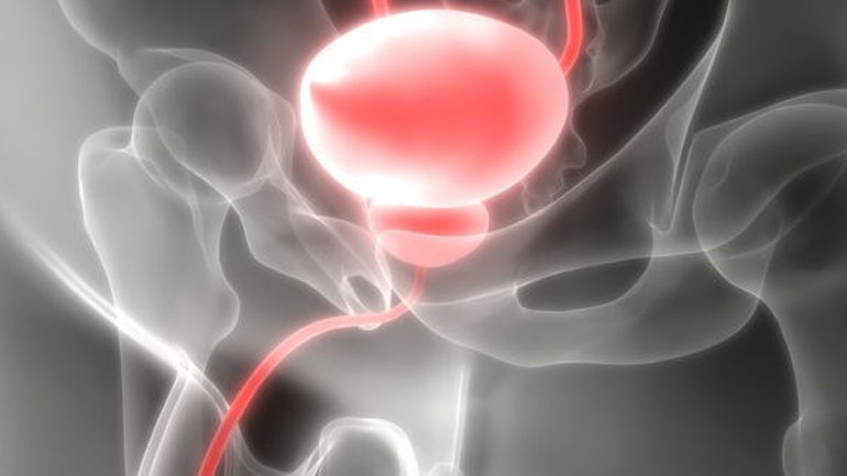 Τι είναι η καλοήθης υπερπλασία του προστάτη και πώς διαγιγνώσκεται;