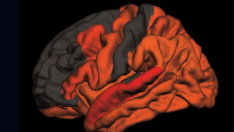 Πρώιμη ένδειξη για Αλτσχάιμερ μπορεί να είναι ο λιγότερο βαθύς νυχτερινός ύπνος