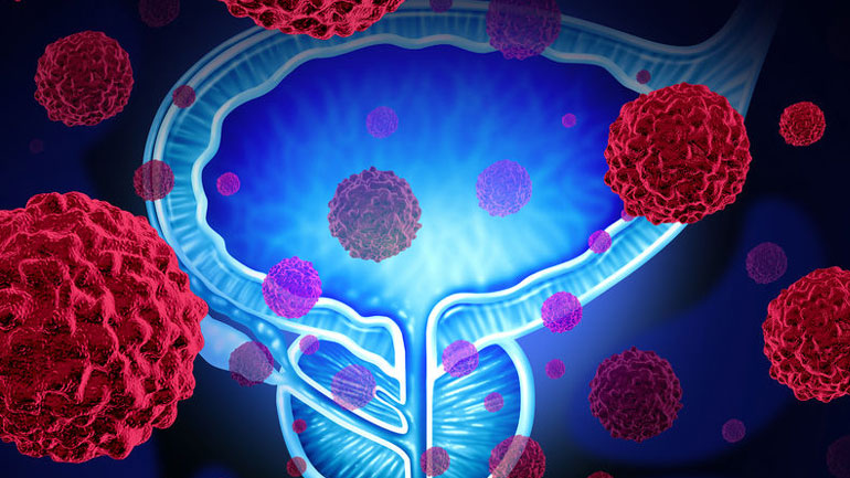 Ικανοποιημένοι οι ασθενείς από την τοποθέτηση πεϊκής πρόθεσης μετά από ριζική προστατεκτομή