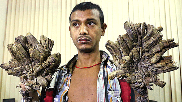 Ο «άνθρωπος δέντρο» από το Μπανγκλαντές και πάλι στο νοσοκομείο