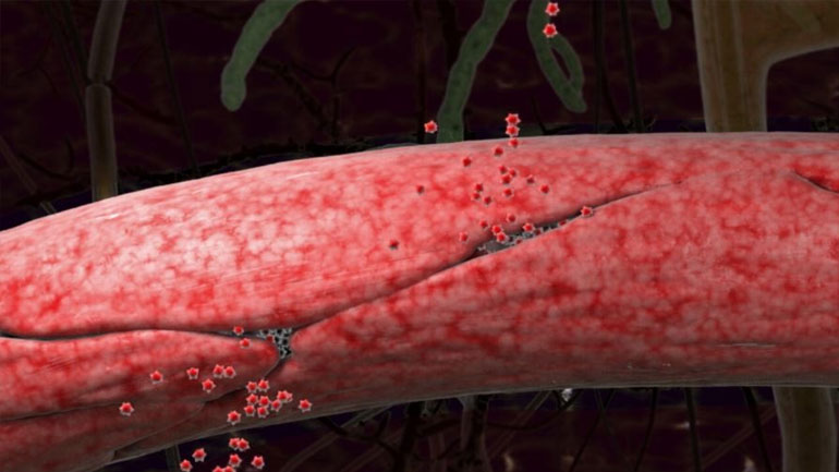 Η νόσος Αλτσχάιμερ μπορεί να συνδέεται με βλάβες στα αιμοφόρα αγγεία του εγκεφάλου