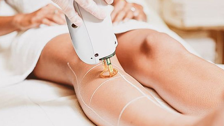 Αποτρίχωση με laser: Όλα όσα πρέπει να γνωρίζετε