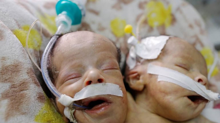 Υεμένη: Πέθαναν τα σιαμαία βρέφη που νοσηλεύονταν σε νοσοκομείο της Σαναά