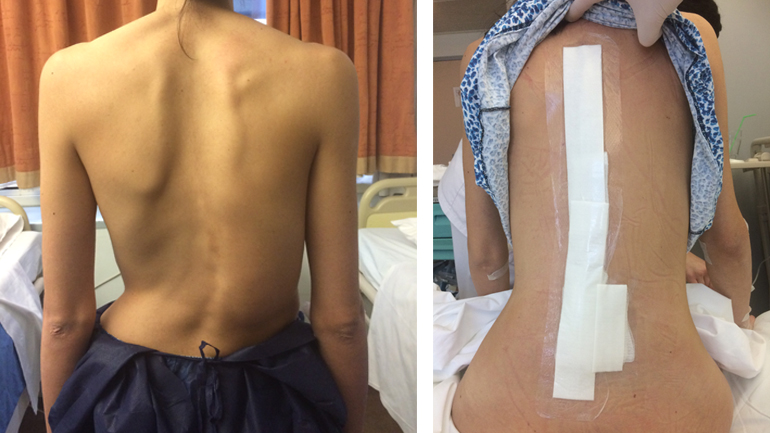 Νεαρή ασθενής 27 ετών με σκολίωση η οποία αντιμετωπίστηκε με ρομποτική χειρουργική της σπονδυλικής στήλης από τον Δρ. Λυκίσσα. Εικόνα πριν και εικόνα 24 ώρες μετά το χειρουργείο.