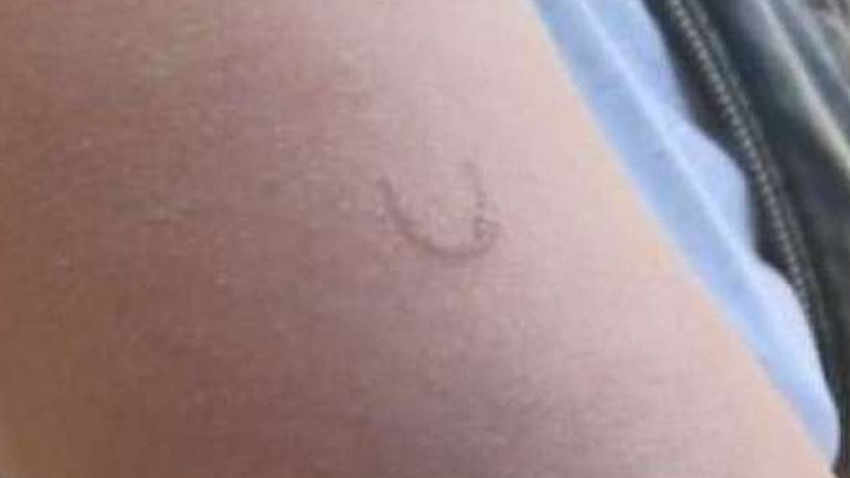 Ανήλικος προκάλεσε έγκαυμα με αναπτήρα σε δύο συμμαθητές του στην Κροατία