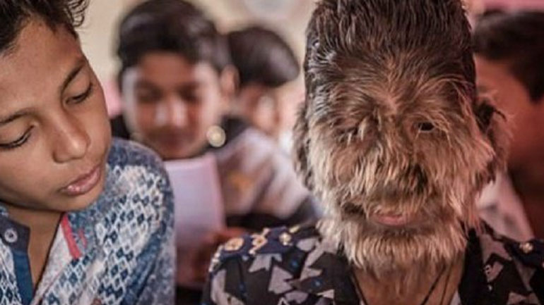 Παιδί-«λυκάνθρωπος» στην Ινδία