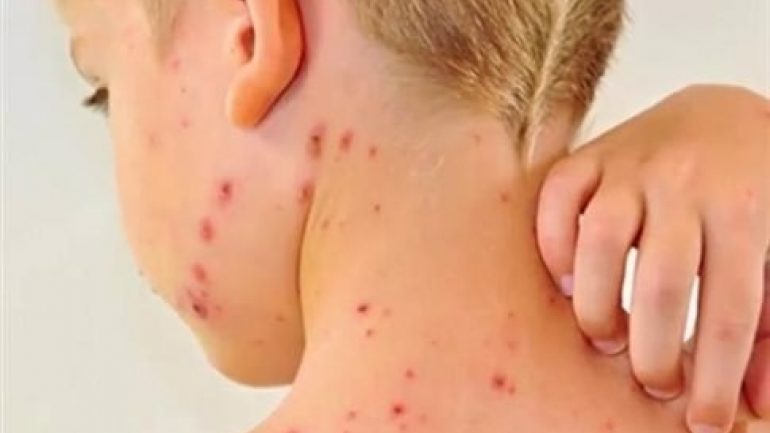 ΠΟΥ: Κατά 50% αυξήθηκαν το 2018 τα κρούσματα ιλαράς σε όλον τον κόσμο