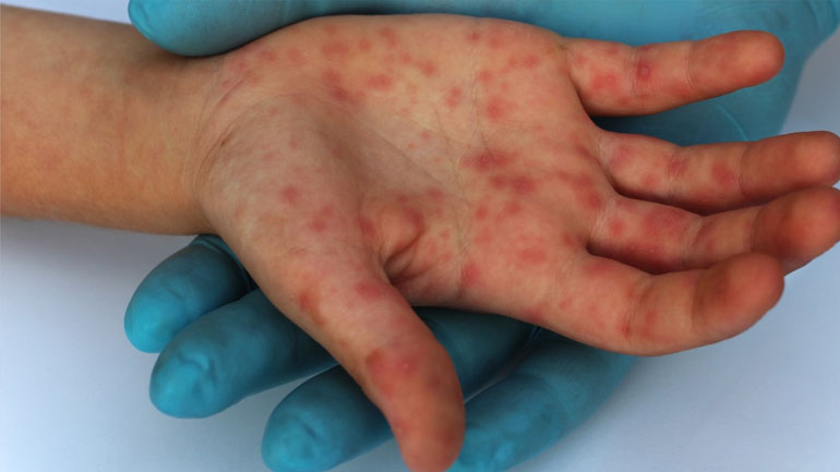 Βουλγαρία: Δεκαπέντε επιβεβαιωμένα κρούσματα ιλαράς