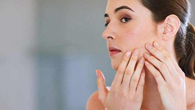 Πώς να αντιμετωπίσεις την ακμή