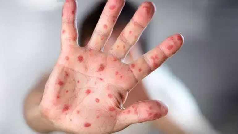 Βουλγαρία: Στα 39 τα επιβεβαιωμένα κρούσματα ιλαράς