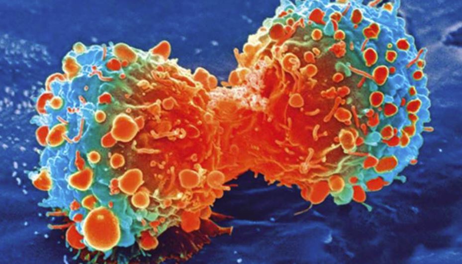 Το στρες προάγει τη μετάσταση του καρκίνου του μαστού