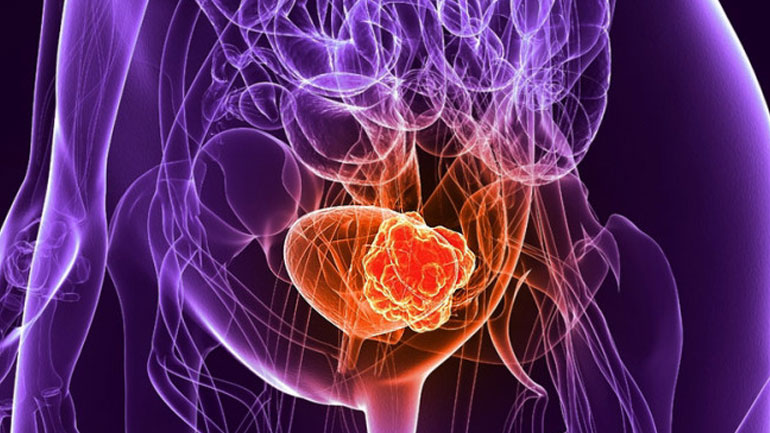 Αυξημένος ο κίνδυνος καρκίνου της ουροδόχου κύστης για τις γυναίκες με πρόωρη εμμηνόπαυση