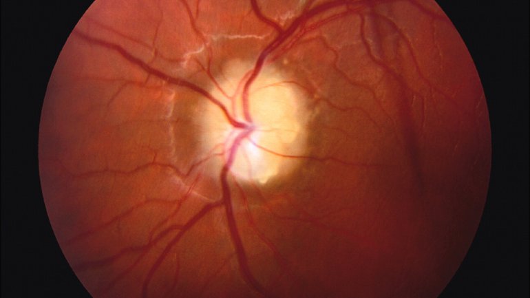 Τα αυξημένα επίπεδα ανδρογόνων στις γυναίκες μπορεί να οδηγήσουν σε τύφλωση