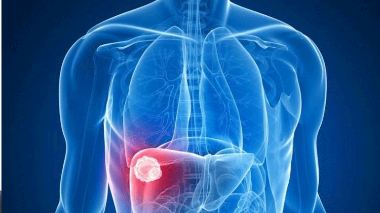 Παράσιτο μετατρέπει τα κύτταρα του ήπατος σε καρκινικά