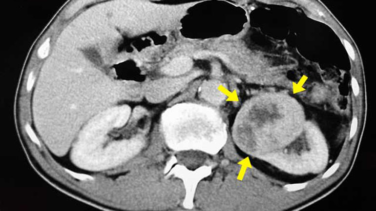 Δημιουργήθηκε επίτηδες πρόγραμμα λογισμικού που εμφανίζει fake καρκίνους