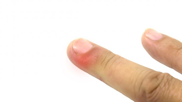 H εξάλειψη των κατεστραμμένων μιτοχονδρίων ανακουφίζει από τη χρόνια φλεγμονή