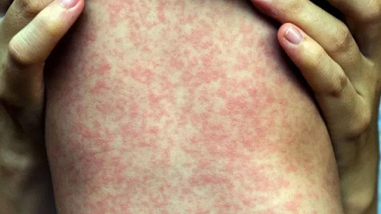 ΗΠΑ: Κατά 300% αυξήθηκαν τα κρούσματα ιλαράς από τις αρχές του έτους