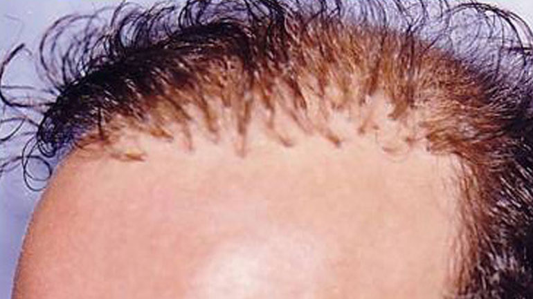Οι δερματολόγοι προειδοποιούν για μεταμοσχεύσεις μαλλιών χαμηλού κόστους