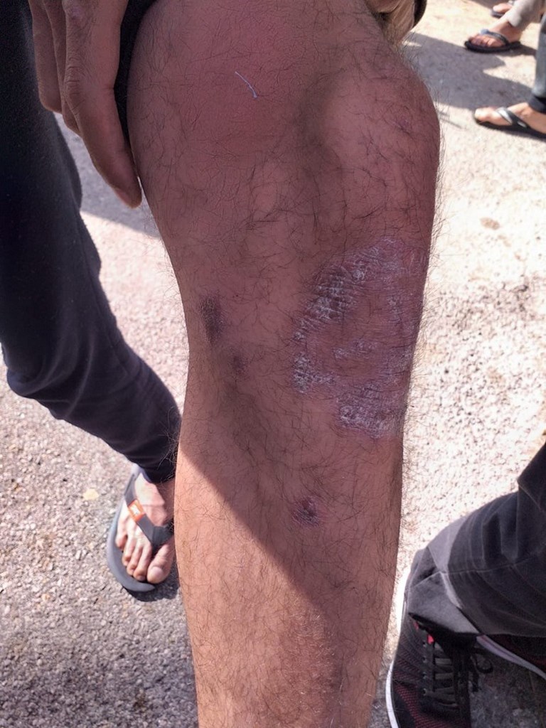 Από τα προβλήματα υγείας που προκύπτουν, δεν προσφέρονται ούτε τα βασικά από υγειονομική περίθαλψη...