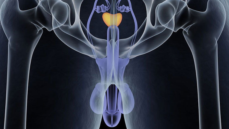 Σύστημα τεχνητής νοημοσύνης είναι σχεδόν εξίσου καλό με τους ακτινολόγους στη διάγνωση του καρκίνου του προστάτη