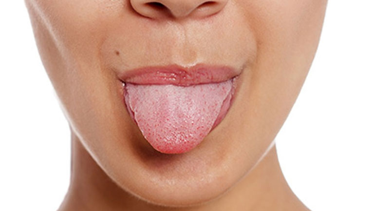 Τι δείχνει το χρώμα της γλώσσας για την υγεία μας;