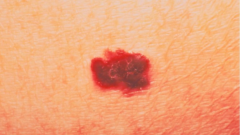 MSD: Εγκρίθηκε από την Ευρωπαϊκή Επιτροπή η χορήγηση του pembrolizumab