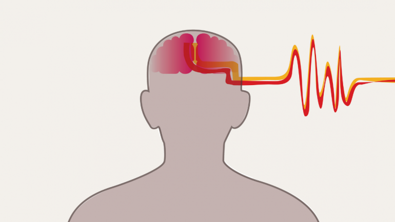 Η διαχρονική μείωση των εγκεφαλικών είναι μεγαλύτερη στους ηλικιωμένους