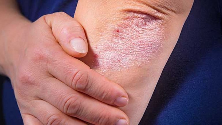 Ψωρίαση: H Ελληνική Δερματολογική και Αφροδισιολογική Εταιρεία υποστηρίζει την εκστρατεία ενημέρωσης της LEO Pharma