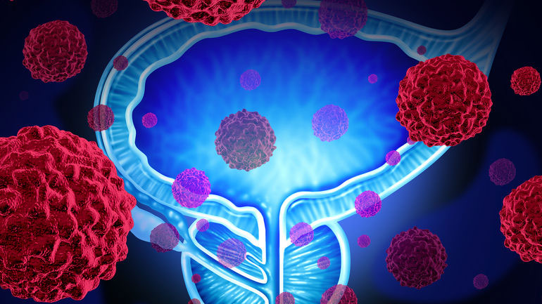 Πότε πρέπει να ξεκινά η χορήγηση σιλδεναφίλης μετά τη ριζική προστατεκτομή;