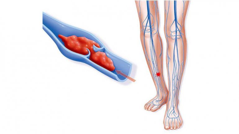 Nέα στοιχεία για την εν τω βάθει φλεβική θρόμβωση