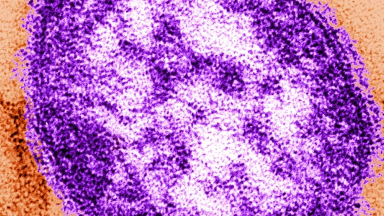 HΠΑ:  Φόβοι επιστροφής μιας ευρείας επιδημίας ιλαράς