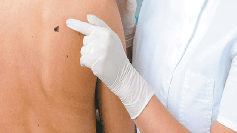 Χαρτογράφηση σπίλων (ελιών)- Ποιες πρέπει να αφαιρέσω