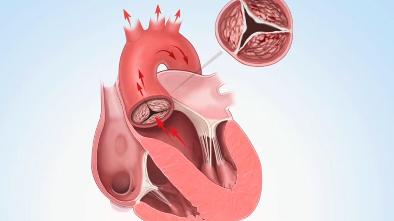 Το υπερβολικό βάρος προκαλεί πράγματι καρδιαγγειακή νόσο και ιδιαίτερα στένωση αορτικής βαλβίδας