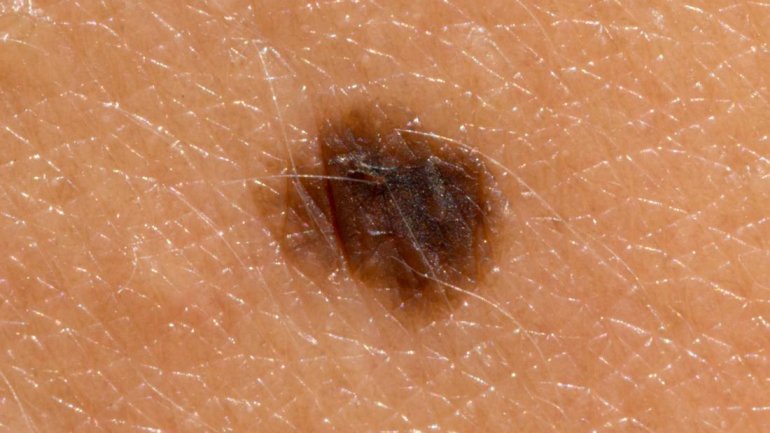 Το μελάνωμα μπορεί να εμφανιστεί και σε δέρμα που δεν βλέπει ο ήλιος