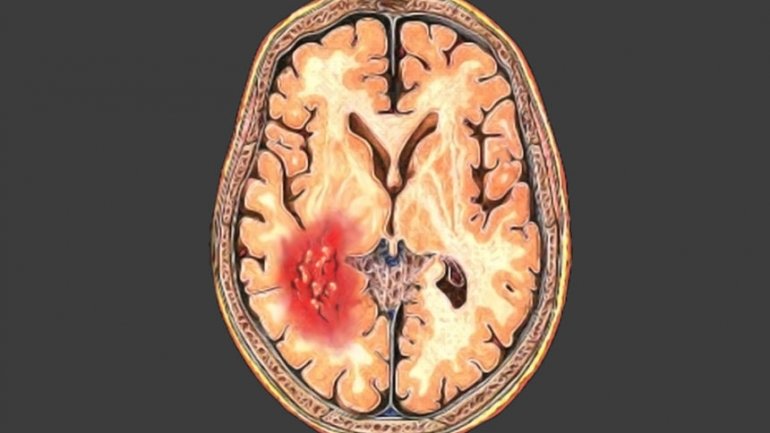 H άσκηση προστατεύει από την υπαραχνοειδή αιμορραγία