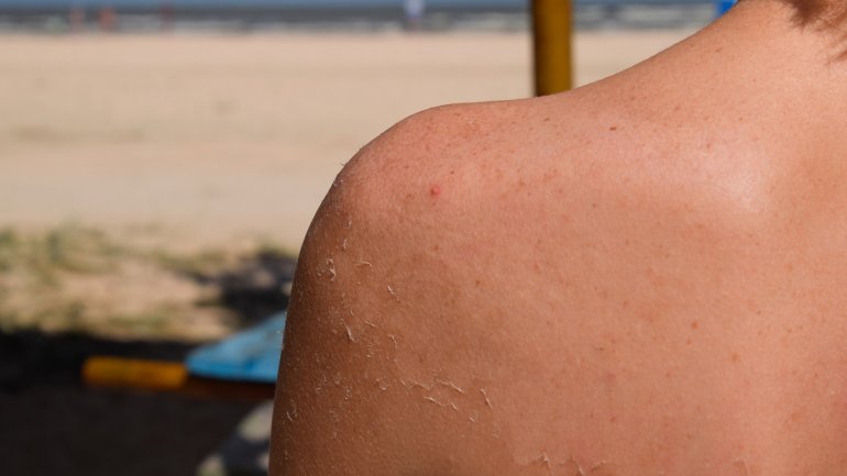 Τρεις περιπτώσεις που μπορεί να πάρετε περισσότερη ηλιακή ακτινοβολία χωρίς να το καταλάβετε