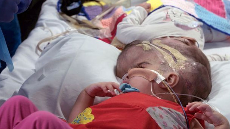 Λονδίνο: Mε επιτυχία διαχωρίστηκαν σιαμαία κορίτσια ενωμένα στο κεφάλι