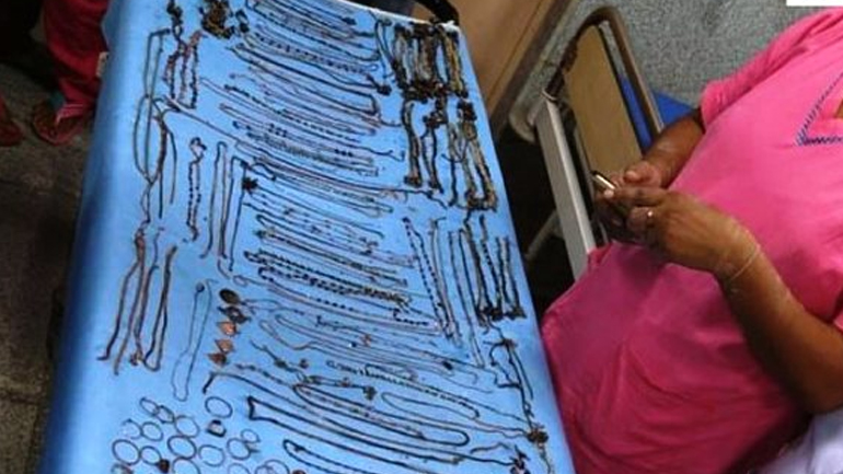 Ινδή είχε καταπιεί κοσμήματα αξίας 60.000 ευρώ