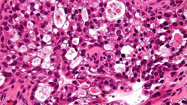 Εξέταση αίματος εντοπίζει τον καρκίνο των ωοθηκών έως και δύο χρόνια νωρίτερα