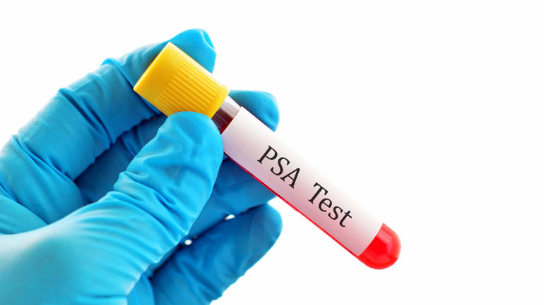 Η παχυσαρκία, το ειδικό προστατικό αντίγονο και η έγκαιρη διάγνωση του καρκίνου