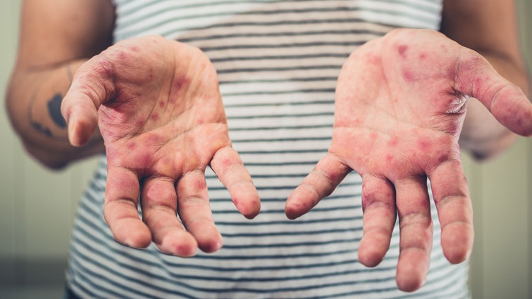 Έξαρση ιλαράς στην Ευρώπη