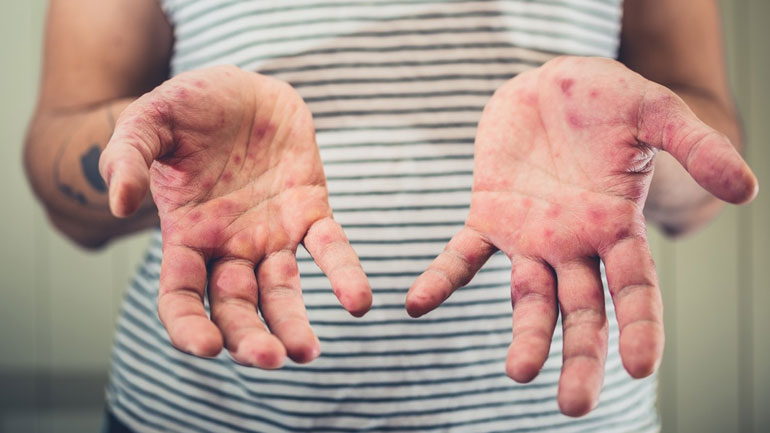 Η Ελλάδα δεν έχει επιδημία ιλαράς εν ενεργεία