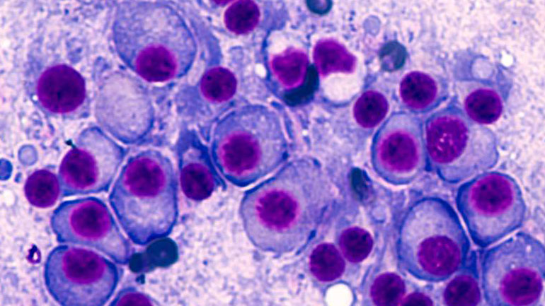 Σημαντική η ανάδειξη του ερευνητικού έργου του ΕΚΠΑ στο Παγκόσμιο Συνέδριο Πολλαπλού Μυελώματος