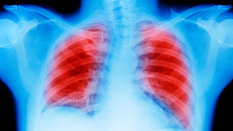 Εκστρατεία ενημέρωσης κατά του Καρκίνου του Πνεύμονα από την AstraZeneca